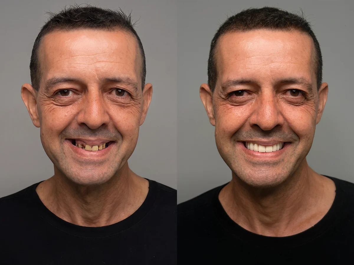 Antes e depois de um paciente que recuperou os dentes fixos na Odonto Excellence Indaial