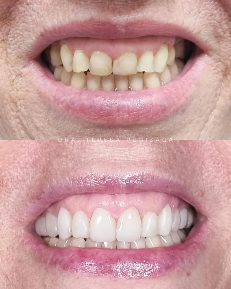Antes e depois de um tratamento com facetas na Odonto Excellence Indaial