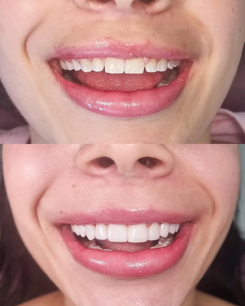 Antes e depois de facetas em dentes anteriores, na Odonto Excellence Indaial