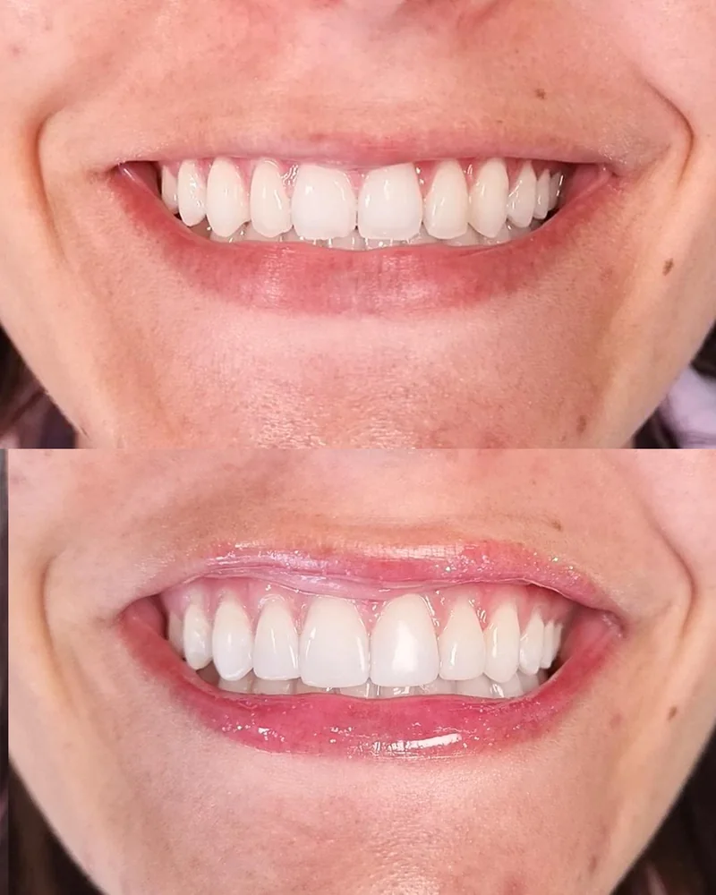 Antes e depois de lentes de contato dental na Odonto Excellence Indaial
