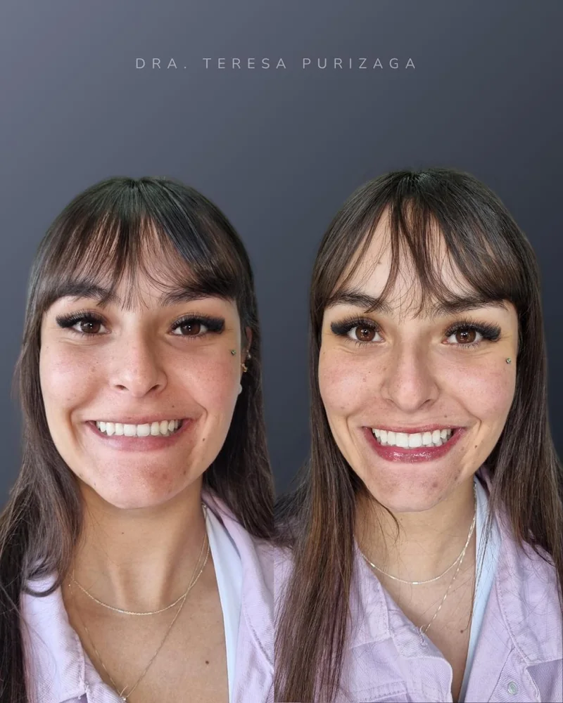 Paciente antes e depois do tratamento com facetas na Odonto Excellence Indaial
